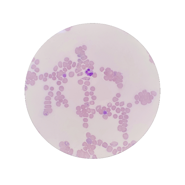 The Power of Reticulocyte Parameters in Laboratory Diagnostics